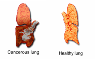 lung cancer