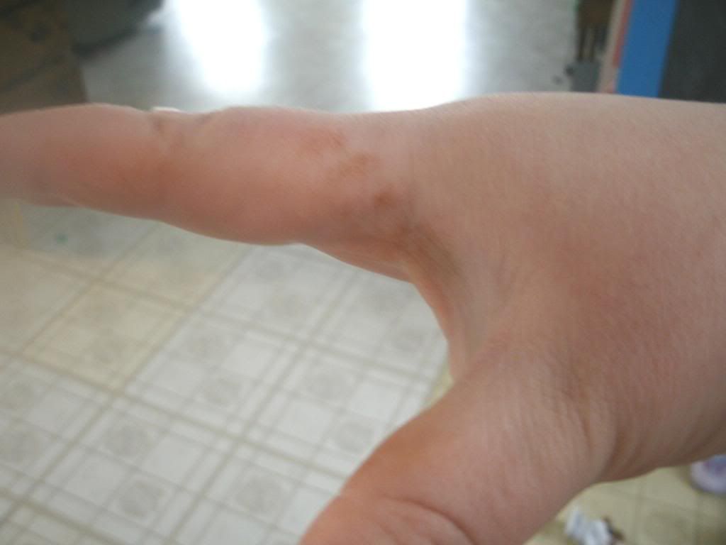 Ot Woke Up To Rust Colored Staining On My Hands Babycenter